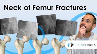 Neck of Femur Fractures  Expert Physio Review [upl. by Lorna]