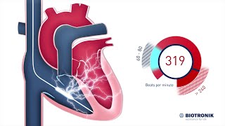 Implantable Cardioverter Defibrillator  How it works [upl. by Larkin]