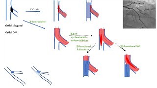 Ostial side branch stenting esp ostial diagonal algorithms and cases Elias Hanna [upl. by Shaer]