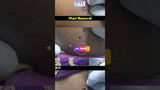 Safe and Effective Wart Removal Treatment [upl. by Ydnirb]