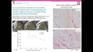 EuroCMR 2016 Debate Tissue characterization using CMR mapping techniques are ready for prime time [upl. by Ratib392]