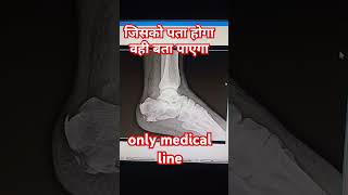 calcaneum fracture ankle joint xray doctor motivation anatomy medicalcareer [upl. by Todd]