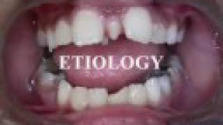 Clinical Pediatric Dentistry Etiology of Supernumerary Teeth [upl. by Lieno]