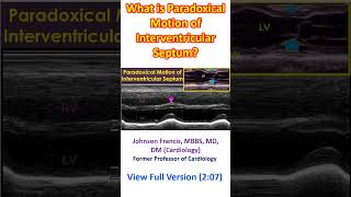 What is Paradoxical Motion of Interventricular Septum [upl. by Paresh601]