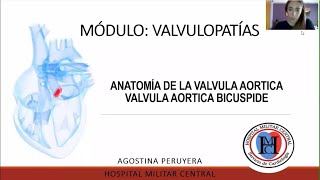 Anatomía valvula aortica valvula aortica bicuspide  Módulo Valvulopatías [upl. by Seiter298]