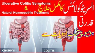 Ulcerative Colitis Treatment  Homeopathic Treatment of Ulcerative Colitis [upl. by Schulze]