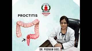 PROCTITISDR POONAM GOEL DR RAJAN GOEL AAROGYADHAM PILES N FISTULA HOSPITAL PANCHKULA [upl. by Harned]