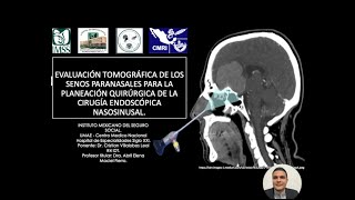 215 Evaluación Tomografía de las variantes anatómicas de los SPN  Dr Villalobos [upl. by Lorilee838]