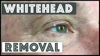 Removing a whitehead from the conjunctival rim [upl. by Gader23]