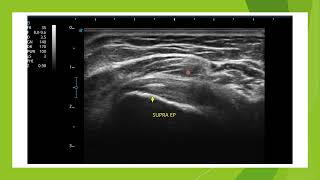 Clivage interstitiel du supra épineux en échographie [upl. by Caneghem]