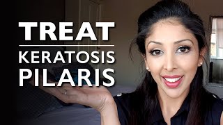 KERATOSIS PILARIS from DOCTOR V  KP Treatment chicken skin  How to treat KERATOSIS PILARIS  DR V [upl. by Dranoel]