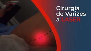 Cirurgia de varizes a LASER  Dr Robson Barbosa de Miranda  Cirurgião Vascular [upl. by Kipper232]