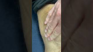 Fluid Bulging from Knee [upl. by Leumek]