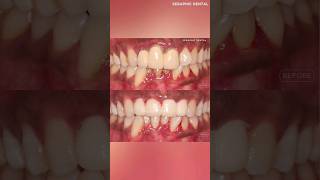 Smile Designing dentist teethtreatment smile dentalcare indore implant shorts trending [upl. by Ahcsatan]