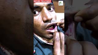 Oral Ulcer  Carcinoma oral Cavity से सही हुए मरीज की फीडबैक ulcer ulcertreatment homeopathy [upl. by Piderit3]