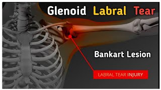 Glenoid labrum tear  Bankart lesion labraltear shoulderdislocation shorts [upl. by Eaner]