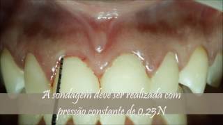 Caso clínico de sondagem periodontal [upl. by Rosemare]