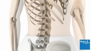 How idiopathic scoliosis occurs  Bupa Health [upl. by Nyasuh636]