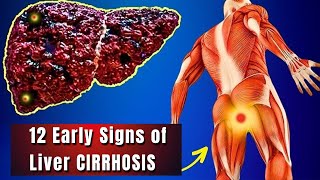 12 Early Signs of Liver Cirrhosis  Warning Signs Your Liver is Dyingquot [upl. by Ttayh]