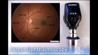 Direct Ophthalmoscopy [upl. by Althee601]