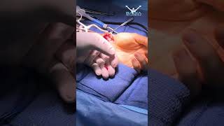 Scaphoid nonunion live surgery recap with Dr Badia [upl. by Chesnut]