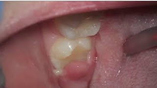 Whats this sore gum on wisdom tooth area explained  Management and treatmentpericoronitis [upl. by Penoyer]