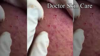 Cystic Acne Pimples amp Whiteheads Extraction On Face Acne Treatmen Part3 [upl. by Annayar]