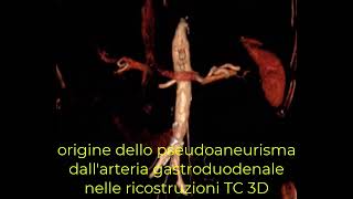 Embolizzazione arteria gastroduodenale con tecnica sandwich [upl. by Ititrefen]