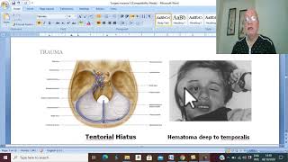 Trauma in English 15 Extradural haemorrhage  part 1   by Dr Wahdan [upl. by Maitilde]