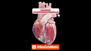 BLOQUEO AURÍCULOVENTRICULAR  MOBITZ I y II  OneCuteMedic [upl. by Gnal254]