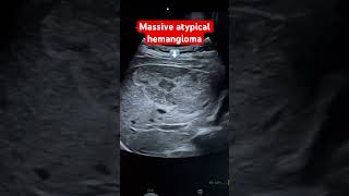 Large atypical liver hemangioma Ultrasound  MRI proved  large benign hepatic mass  ARDMS [upl. by Vacuva]