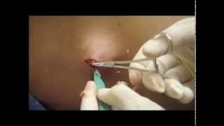 Cyst Removal NYC  212 6449494  NYC Cyst Removal  New York NY [upl. by Perron]