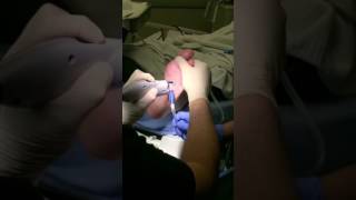 Plantar Wart Removal [upl. by Eey]