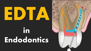 EDTA in Root Canal Treatment [upl. by Luar515]