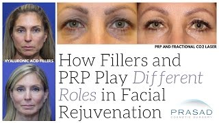 How Fillers and PlateletRich Plasma PRP Play Different Roles in Facial Rejuvenation [upl. by Nehtanoj787]