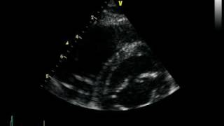 ARVC ARRHYTHMOGENIC RIGHT VENTRICULAR CARDIOMYOPATHY DAVD [upl. by Tearle]