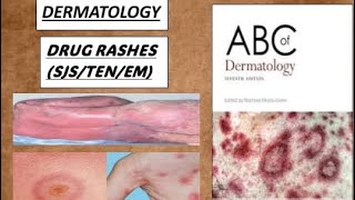 DERMATOLOGY DRUG RASHES Steven Johnson syndrome toxic epidermal necrolysis erythema multiform [upl. by Lanette237]