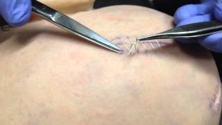 How to remove a running suture [upl. by Aelem]