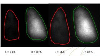 IAEAESNM Webinar  Lung Perfusion Scintigraphy in Paediatric Cardiology [upl. by Trebo686]