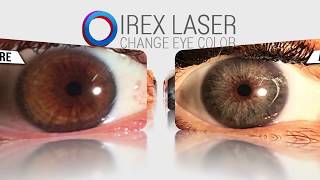 Permanently change your eye color with iREX Laser [upl. by Rafferty]