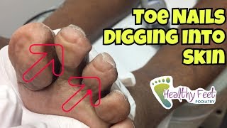 Nails Curling Into Toes  Nail Trimming for Diabetic Ingrown Nails at the Ends of the Toe [upl. by Griswold]