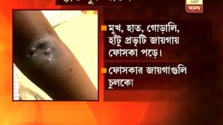 New disease in Kolkata hand foot mouth disease [upl. by Ruzich477]