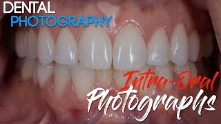 Dental Photography Basics  Dental Photography Techniques  Intraoral Photographs [upl. by Neryt]