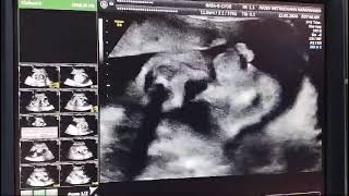 Interesting case of Antenatal ScanAnomaly Scan at Ayush Scan Centres [upl. by Annnora851]