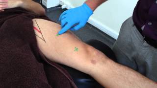 Dry Needling Vastus Medialis [upl. by Burrus]