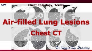 Air filled lung lesions CT Terms [upl. by Louth]