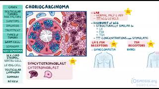 Testicular Tumors  Osmosis [upl. by Drawyah550]