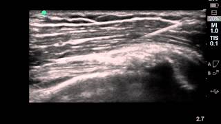 Left Biceps Tendon SVF  Stem Cell Therapy  Stem Cell Injection [upl. by Odawa]