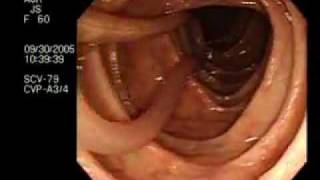 Worm Intestine Ascariasis [upl. by Aun]