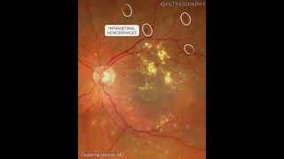 DIABETIC MACULAR EDEMA MULTIMODAL ANALYSIS For more images like this visit wwwretinographyorg ret [upl. by Oir]